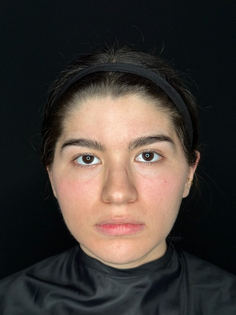 Botox & Dysport Before & After