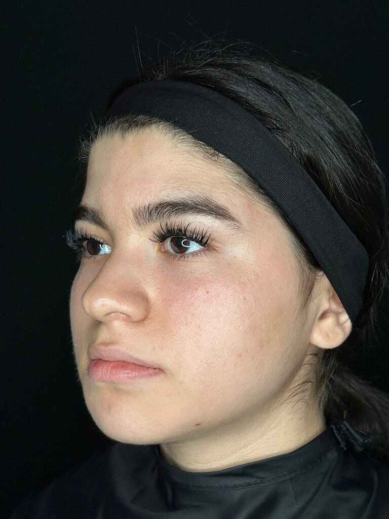 Botox & Dysport Before & After