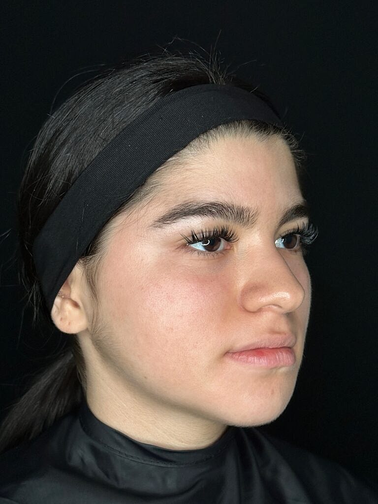 Botox & Dysport Before & After
