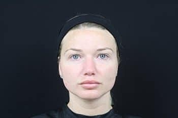 Botox & Dysport Before & After