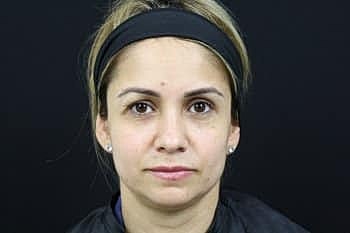 Botox & Dysport Before & After