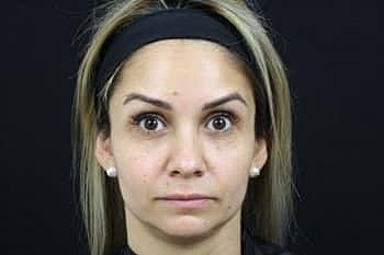 Botox & Dysport Before & After