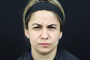 Botox & Dysport Before & After