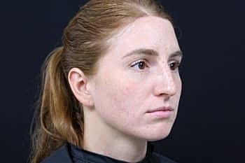 Botox & Dysport Before & After