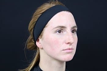 Botox & Dysport Before & After