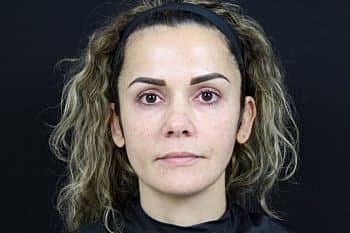Botox & Dysport Before & After