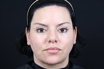 Botox & Dysport Before & After