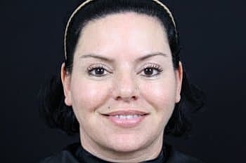 Botox & Dysport Before & After