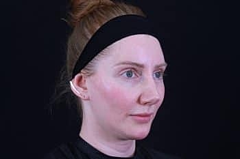 Botox & Dysport Before & After