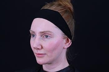 Botox & Dysport Before & After