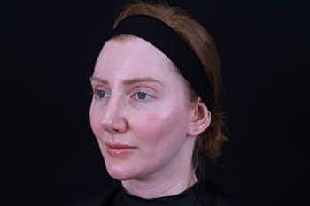 Botox & Dysport Before & After