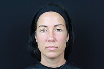 Botox & Dysport Before & After