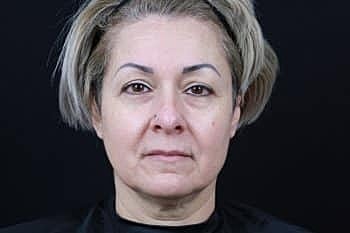 Botox & Dysport Before & After