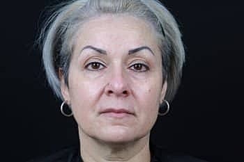 Botox & Dysport Before & After