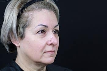 Botox & Dysport Before & After