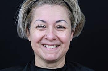 Botox & Dysport Before & After