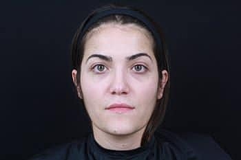 Botox & Dysport Before & After