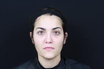 Botox & Dysport Before & After