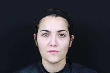 Botox & Dysport Before & After