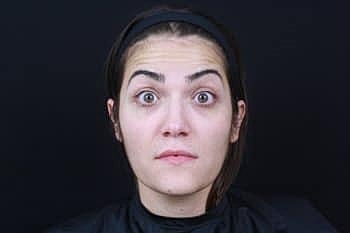Botox & Dysport Before & After