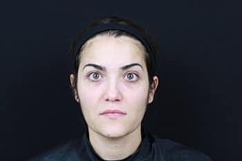 Botox & Dysport Before & After