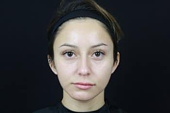 Botox & Dysport Before & After