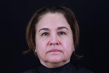 Skin Rejuvenation Before & After