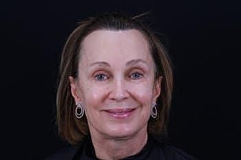 Skin Rejuvenation Before & After