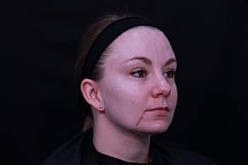 Skin Rejuvenation Before & After