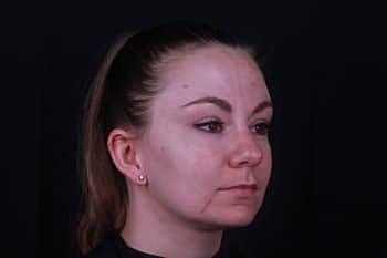 Skin Rejuvenation Before & After