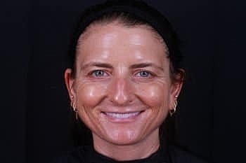 Skin Rejuvenation Before & After