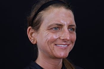 Skin Rejuvenation Before & After