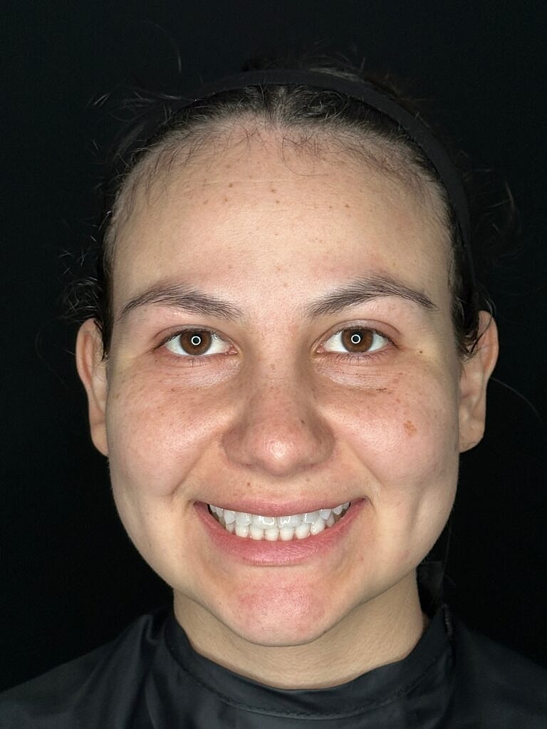Skin Rejuvenation Before & After