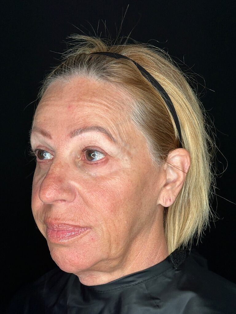 Skin Rejuvenation Before & After