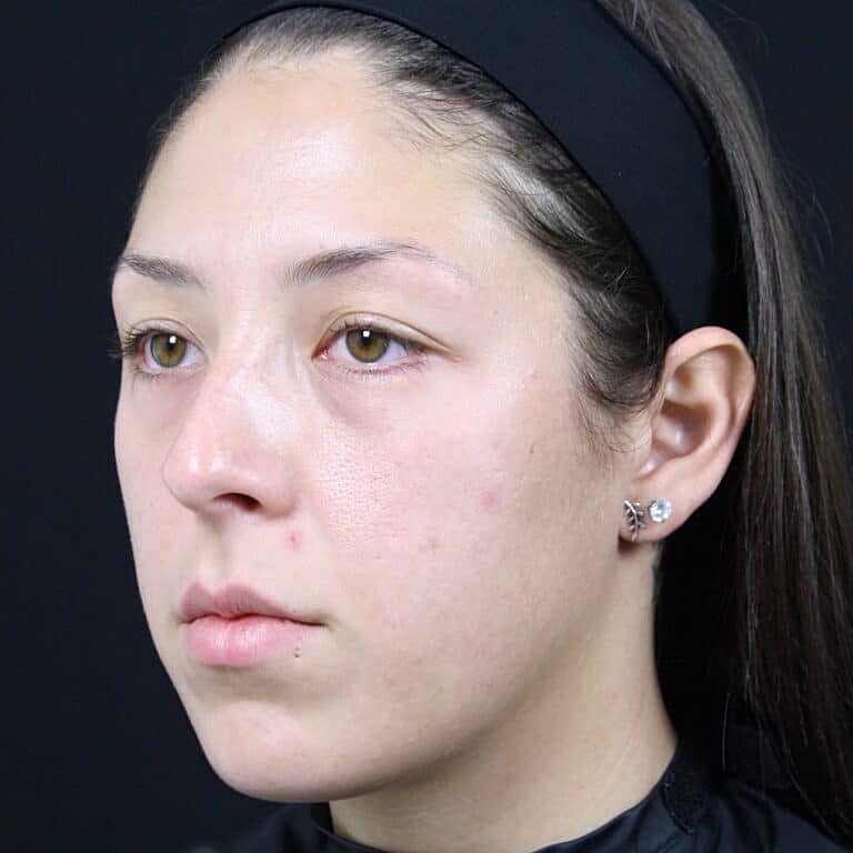 Skin Rejuvenation Before & After