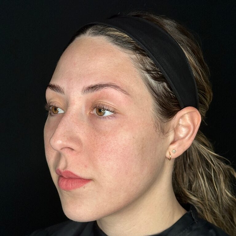Skin Rejuvenation Before & After