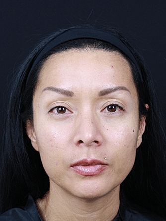 Skin Rejuvenation Before & After