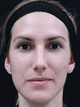 Skin Rejuvenation Before & After