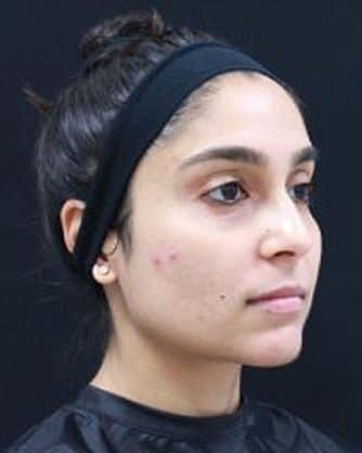 Skin Rejuvenation Before & After