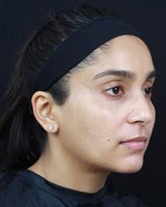 Skin Rejuvenation Before & After