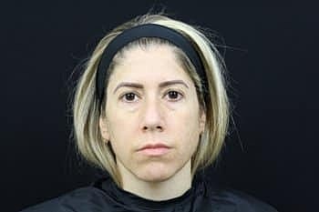 Skin Rejuvenation Before & After