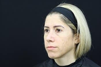 Skin Rejuvenation Before & After