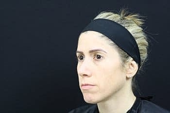Skin Rejuvenation Before & After
