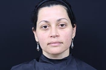 Skin Rejuvenation Before & After