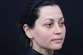 Skin Rejuvenation Before & After