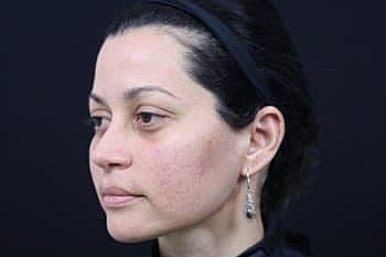 Skin Rejuvenation Before & After