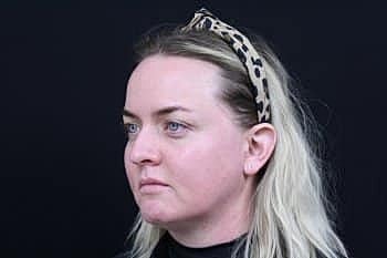 Skin Rejuvenation Before & After