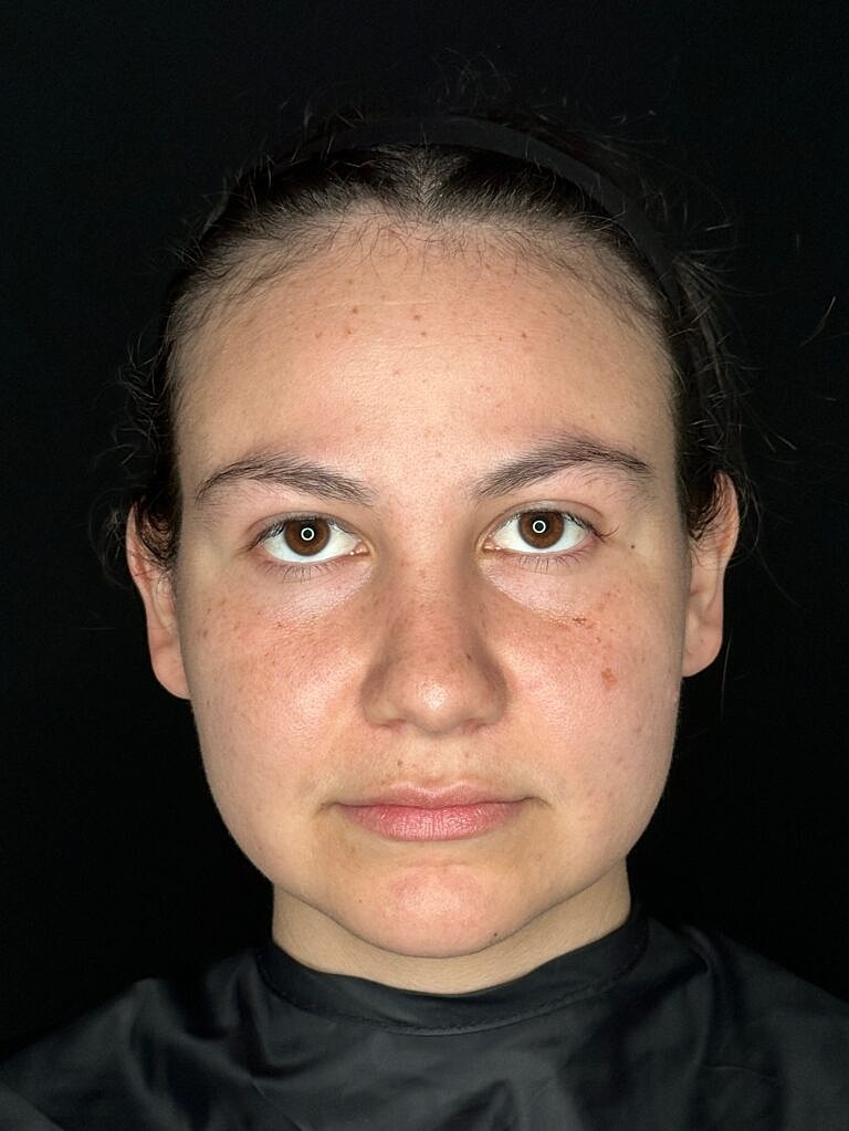 Thermage Before & After
