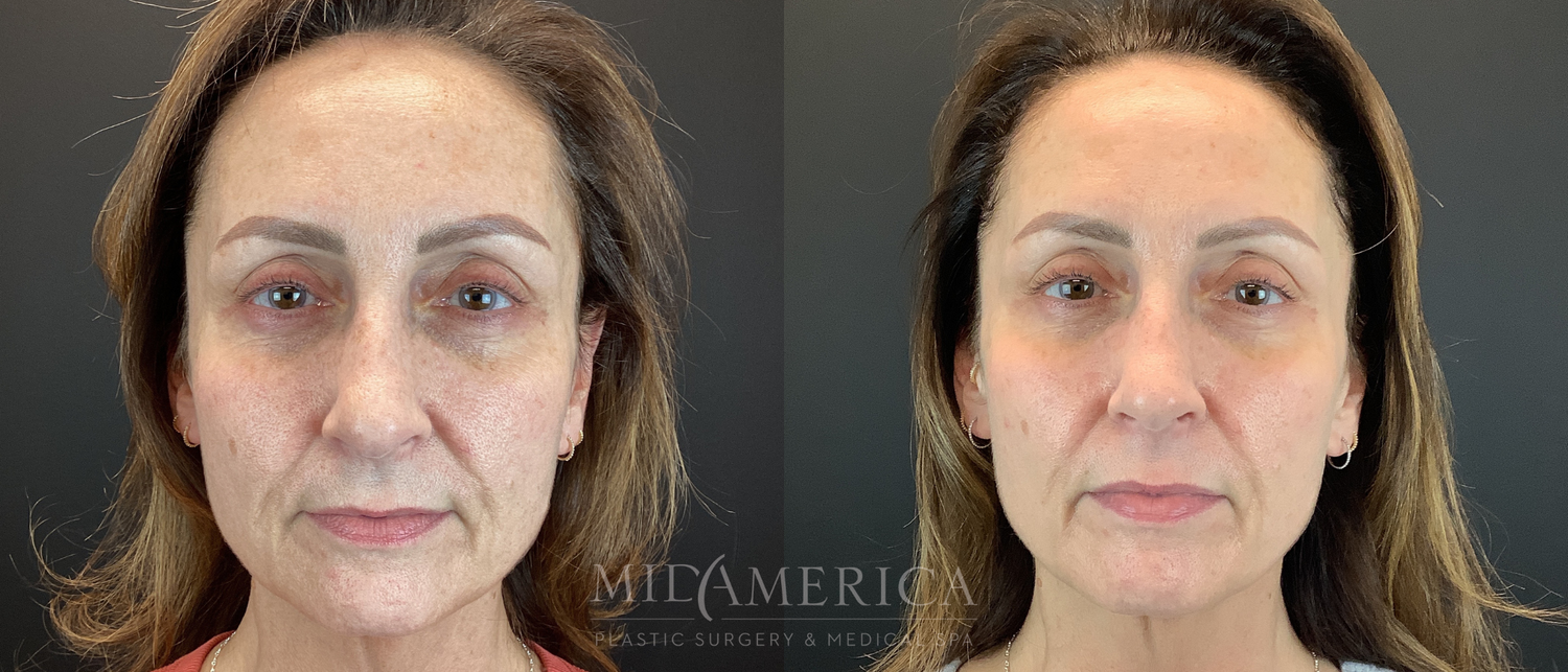 Sculptra Before & After