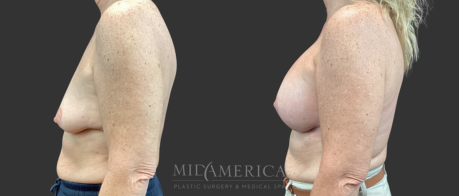 Breast Augmentation & Lift Before & After